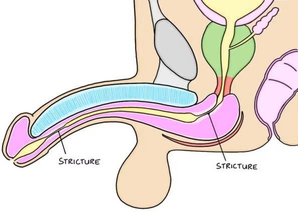 Illustration showing urethral stricture locations along the male urethra